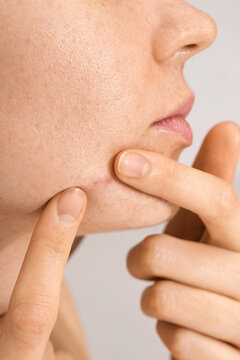 Acne problems skin 