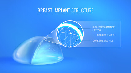 Breast implant in section with material infographic. Realistic prosthesis for breast enlargement - mammoplasty. Vector illustration on a bright blue background