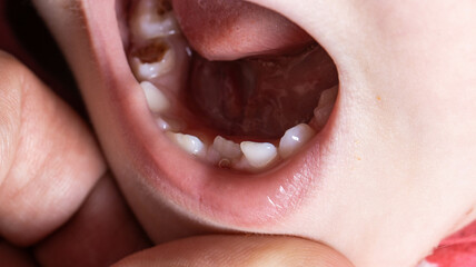 Crooked teeth in a child's mouth. The permanent tooth grows next to the milk tooth, close-up