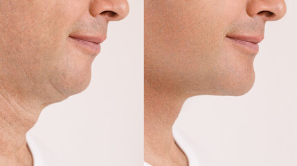 A close portrait of an aged man before and after the facial rejuvenation procedure. Correction of...