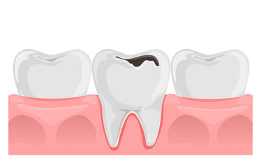 Teeth with caries in gum. Dental anatomy. Flat vector illustration isolated on white background.