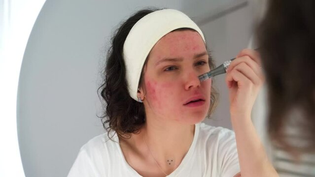DIY Skincare Gone Wrong: Young Woman Attempts Dermapen Procedure at Home, Regrets Not Seeking Professional Help. Close Up of Girl Painful, Red Skin, Acne Scars Wrinkles. Warning for Beauty Enthusiasts