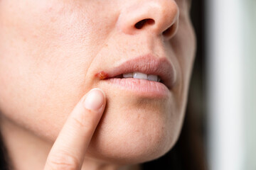 The woman with a virus herpes on lips. Herpes blisters. - obrazy, fototapety, plakaty