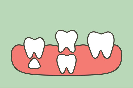 teeth are growing up from the gum by permanent tooth located below primary tooth, first tooth - dental cartoon vector flat style