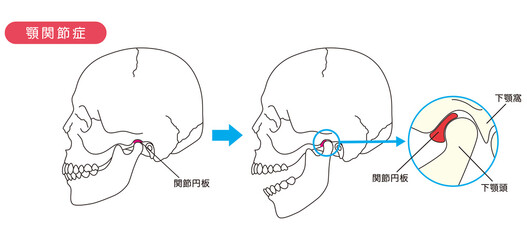 顎関節症の説明図