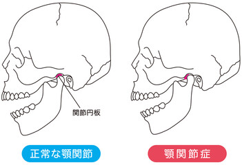 正常な顎関節と顎関節症の比較 © koti