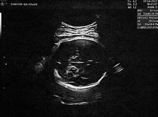 Pregnant baby infant ultrasound display. Mother belly screen in hospital. Womb scan