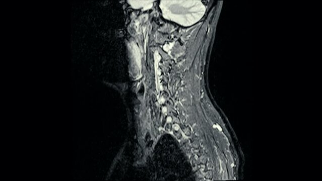 Magnetic Resonance images ( MRI ) of cervical spine sagittal. C5 ,C6, C7 injured disc disease