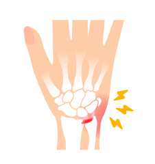 TFCC injury Vector illustration