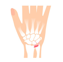 About TFCC  Vector illustration