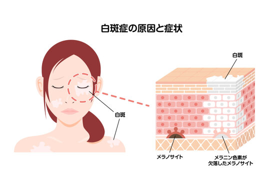 白斑(はくはん)の原因と症状イラスト (皮膚断面図図解)