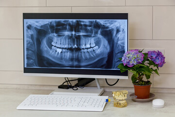 A table in the dentist's office with a computer on the screen, an X-ray image of the jaw,