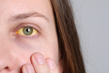 Obraz premium Woman with yellow eyes on light background, closeup. Symptom of hepatitis