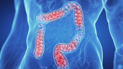 3d medical illustration of the microbiome of an inflamed colon - 594035207