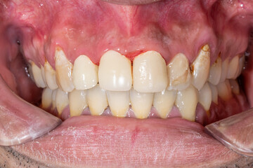 Dentistry patient with visible unaesthetic prosthodontic crowns in the incisors and bloody gingival gum with gingivitis. Fake teeth located in the anterior sector with aesthetic and fonction condition