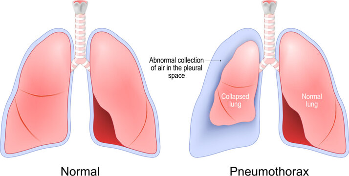 Pneumothorax. Normal, and collapsed lungs.