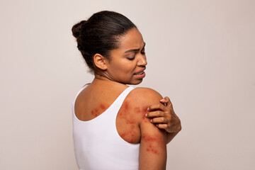 Black woman scratching red spots on her skin - obrazy, fototapety, plakaty