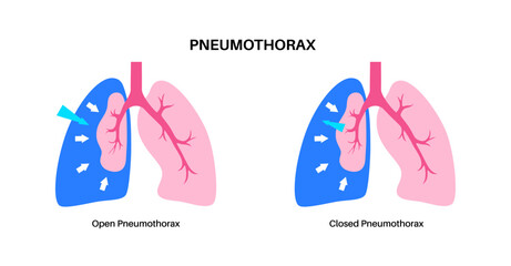 Pneumothorax anatomical poster