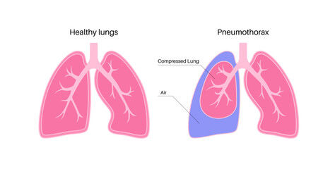 Pneumothorax anatomical poster