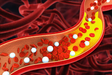 Cholesterol blocked artery. The accumulation of cholesterol in the blood vessels. 3d illustration