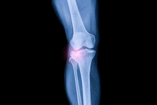 Knee x ray after car accident in orthopedic unit inside trauma hospital.X-ray shows tibia plateau bone fracture.Patient needs surgery.Xray technology in blue on black background.Red light effect.