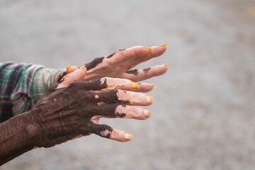 Hands of an old black man with the vitiligo skin disease on the blurred background