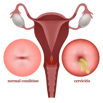 Inflammation of the cervix. Infographic showing the disease. Medical poster, vector illustration