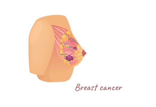 Concept Mammary glands female breast cancer. The illustration is a flat design cartoon concept of a female breast depicting the anatomy of the mammary glands affected by cancer. Vector illustration.