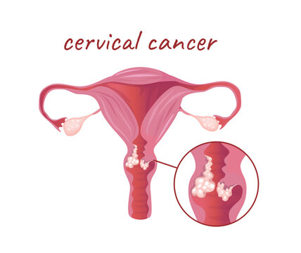 Concept Female anatomy uterus cervical cancer. This illustration depicts a flat, vector, cartoon design of the anatomy of the uterus affected by cancer. Vector illustration.