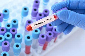 Naklejka premium Doctor holding a test blood sample tube with Vitamin A test on the background of medical test tubes with analyzes.Banner. Copy space for text