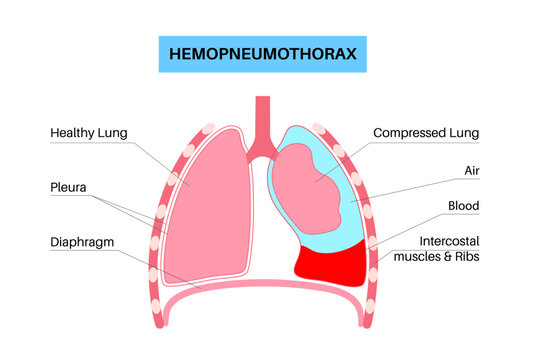 Hemopneumothorax medical poster