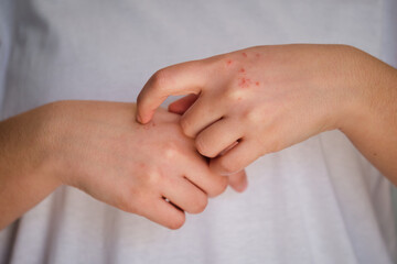 Fototapeta na wymiar Woman scratching itchy eczema on her hand. Dermatitis, allergy, psoriasis concept.