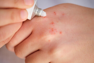Woman applying white medical corticosteroid ointment on eczema on her hand. Dermatitis, allergy, psoriasis concept.