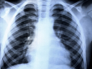 Close-up chest x-ray. Chest x-ray for the diagnosis of lung diseases. X-ray of organs mid adult men, medical examination