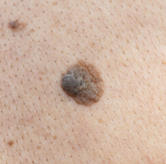 large mole on the skin as a background.