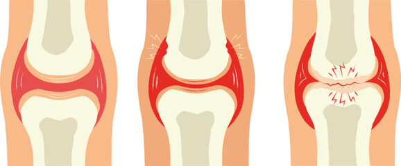 Knee joint pain. Vector illustration isolated on a white background.