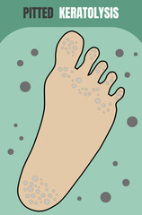 Bacterial infection the skin on feet that like pits and malodour