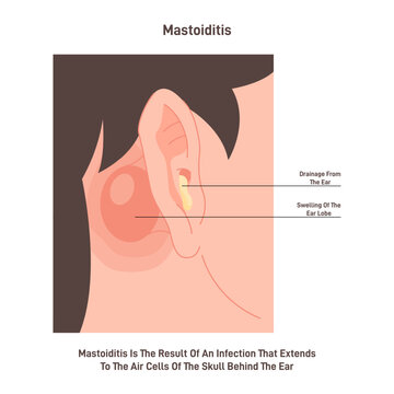 Mastoiditis. Inflammatory disease of the ear. Bacterial mastoid