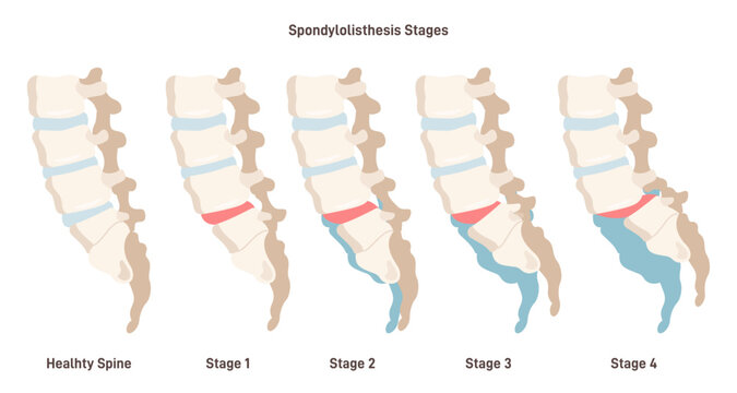 Spondylolisthesis. Spinal disease when lower vertebrae slip forward
