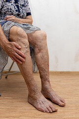 Cropped elderly woman showing by hand bare legs with varicose veins inflammation. Need laser...