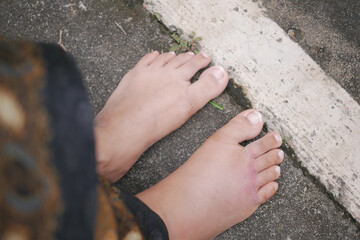 close up of women feet with swelling 