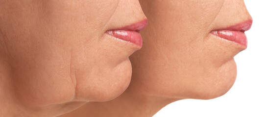 Obraz premium Double chin problem. Collage with photos of mature woman before and after skin tightening treatments on white background, closeup