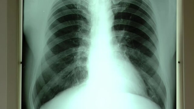 X-ray of Chest, Doctor Examining X-ray of Chest in Hospital. Close Up.