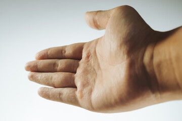 a hand with dyshidrotic or pompholyx eczema illness selective focus