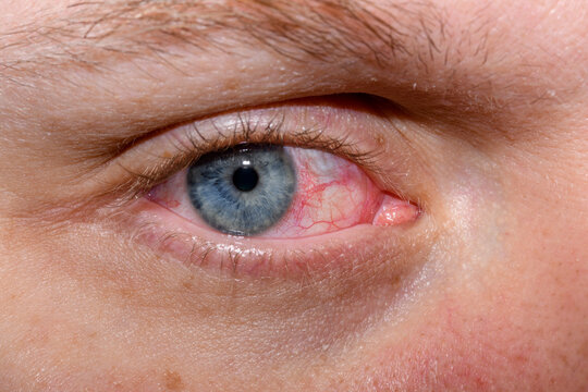 Niebieskie otwarte oko z zapaleniem spojówek 