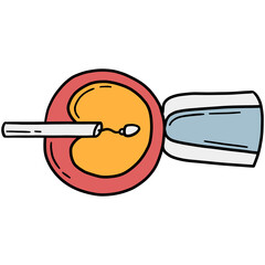 Intracytoplasmic sperm injection ICSI