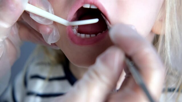 dentist, doctor examines oral cavity of small patient, uses mouth mirror, closeup baby teeth child, concept pediatric dentistry, dental treatment, correction of occlusion, oral care, caries prevention