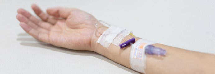 Arm puncture for intravenous infusion or medication for hospitalized patients, Treatment of patients with intravenous injections to allow the patient to receive the drug directly.
