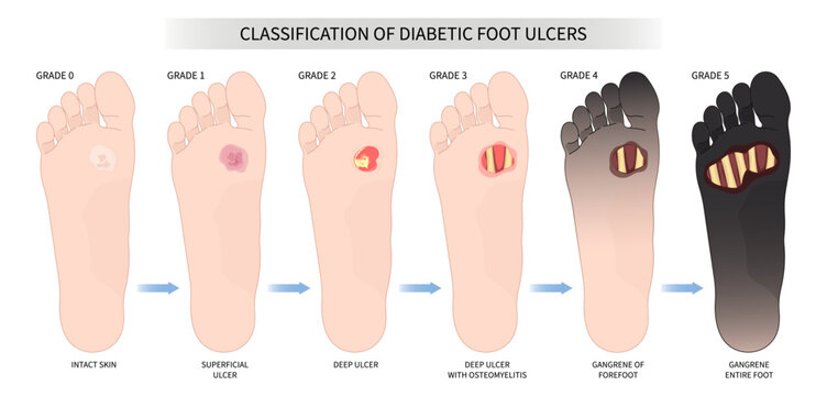  Necrotizing Fasciitis Images Browse 111 Stock Photos Vectors And 