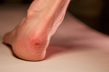 Callus on a man's leg close-up. A man is suffering from pain due to a callus on the heel of his foot. The problem is due to tight shoes.